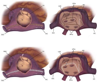 Concomitant ablation for non-paroxysmal atrial fibrillation: combined energy versus cryoablation alone